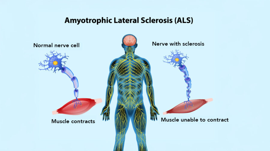 ALS and Aid in Dying | Academy of Aid-in-Dying Medicine